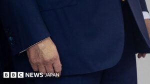 トランプ氏は静脈の疾患と診断、ホワイトハウスが発表 手のあざめぐり憶測