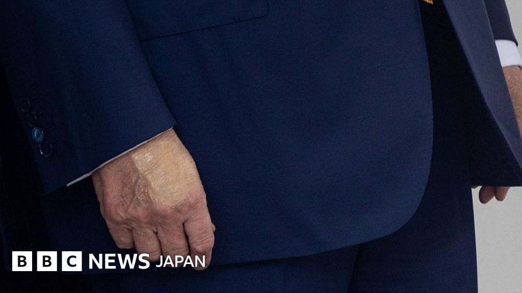 トランプ氏は静脈の疾患と診断、ホワイトハウスが発表 手のあざめぐり憶測